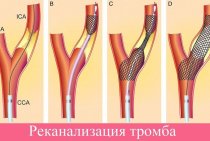 Trombu rekanalizācijas īstenošanas iezīmes